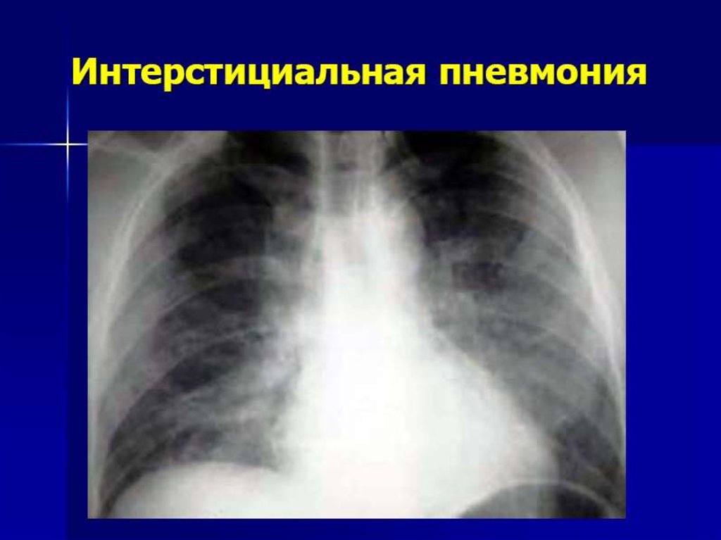 Интерстициальная пневмония у взрослых что это. Интерстициальная пневмония рентген. Вирусная пневмония рентгенологическая картина. Интерстициальные заболевания легких рентген. Вирусная пневмония на рентгенограмме.