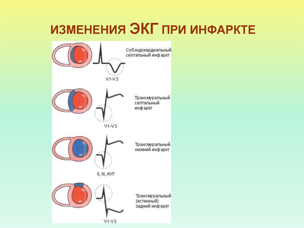 Признаки трансмурального инфаркта