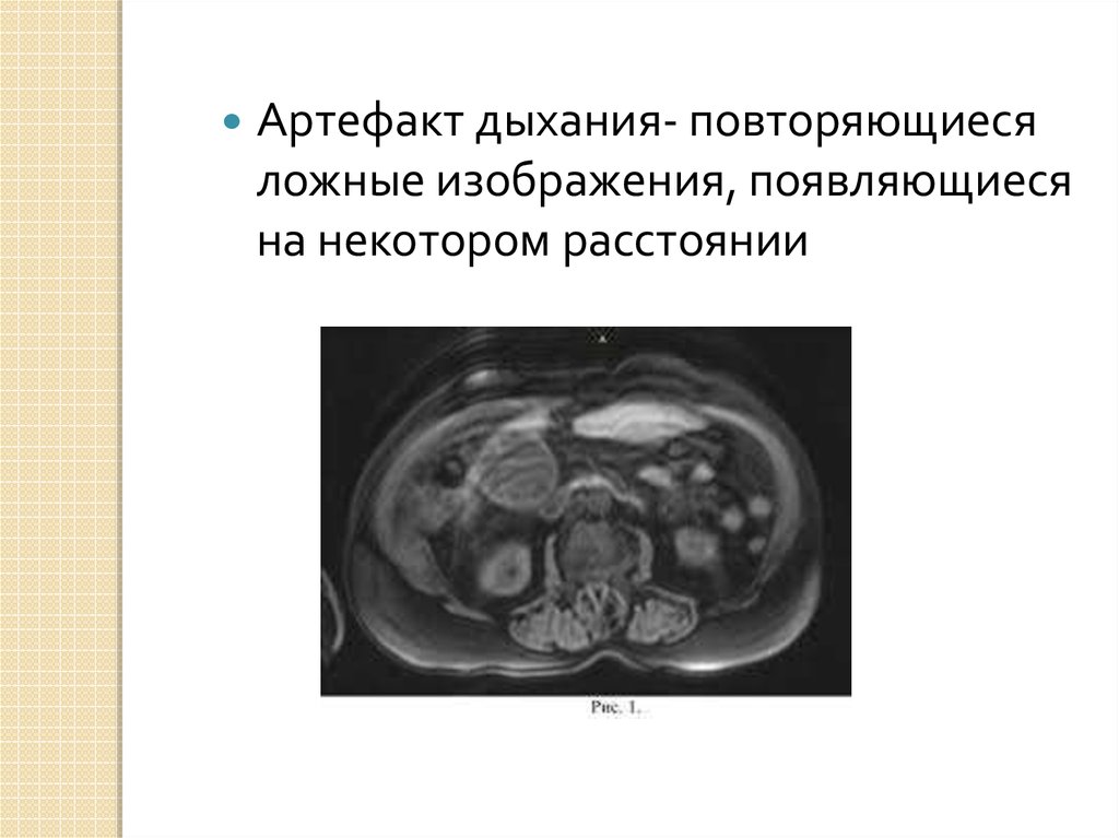 Артефакты мрт презентация