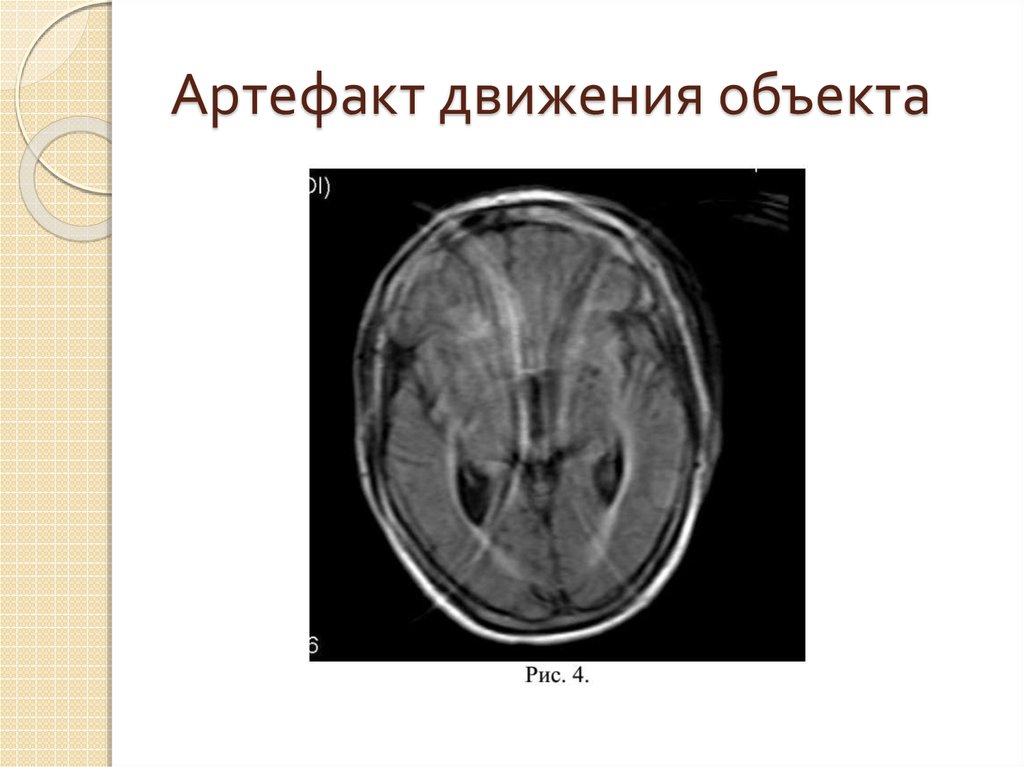 Артефакты мрт презентация