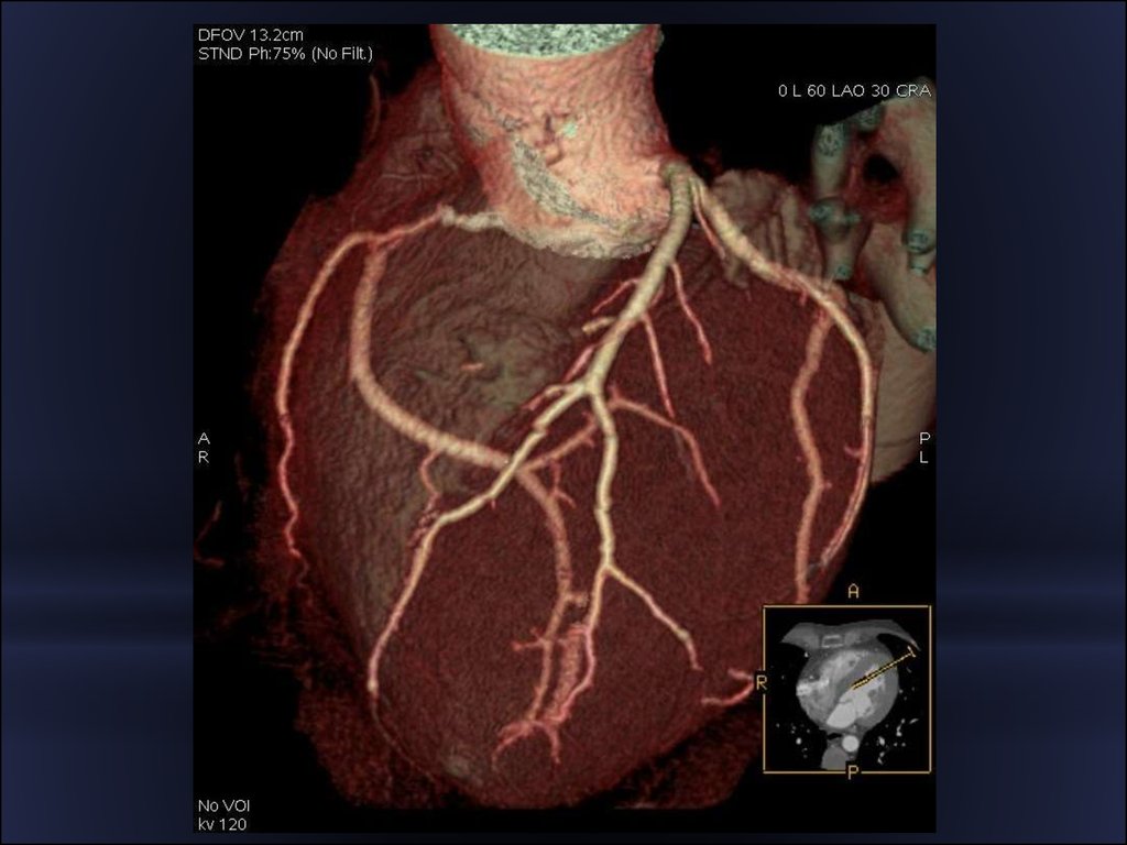 Коронография что такое. Кт-ангиография коронарных артерий. Кт коронарография сосудов. Мультиспиральная кт сердца сосудов сердца. Мультиспиральная кт коронарных сосудов.