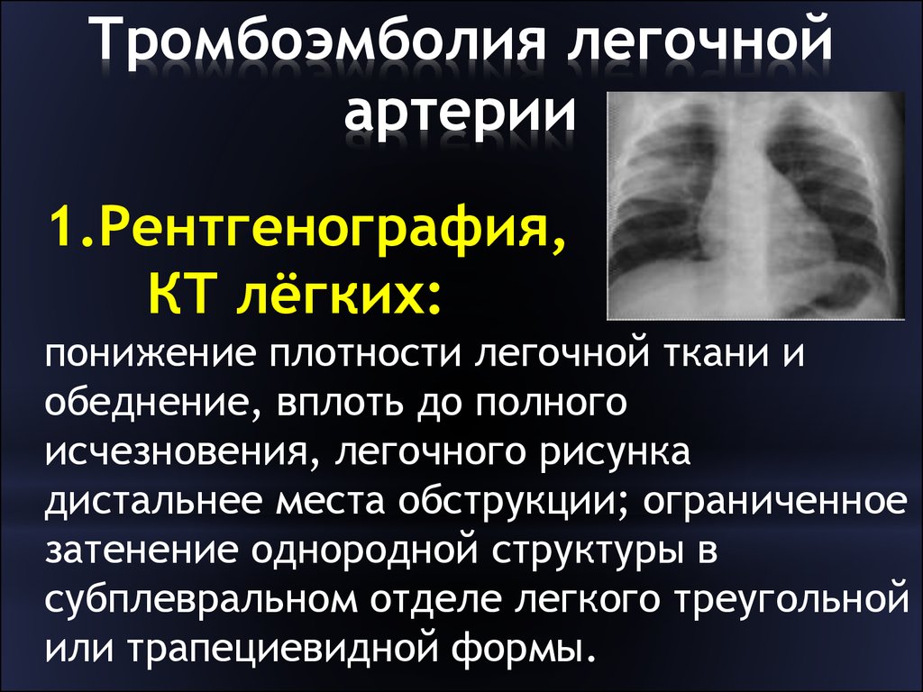 Тромболия легочной артерии. Рентгенологический синдром тромбоэмболии легочной артерии:. Тромбоэмболия лёгочной артерии симптомы рентген. Клинический признак тромбоэмболии легочной артерии. Тромбоэболиялегосной артерии.
