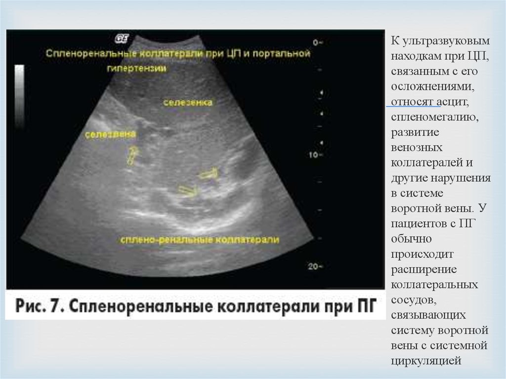 Печень диффузно неоднородная что это. Синдром портальной гипертензии УЗИ. Портал ная гипертензия УЗИ. УЗИ органов брюшной полости при портальной гипертензии. УЗИ критерии портальной гипертензии.