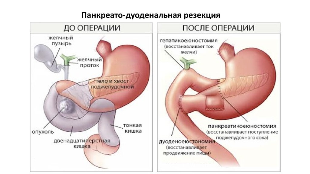 Панкреатодуоденальная резекция ход операции в схемах