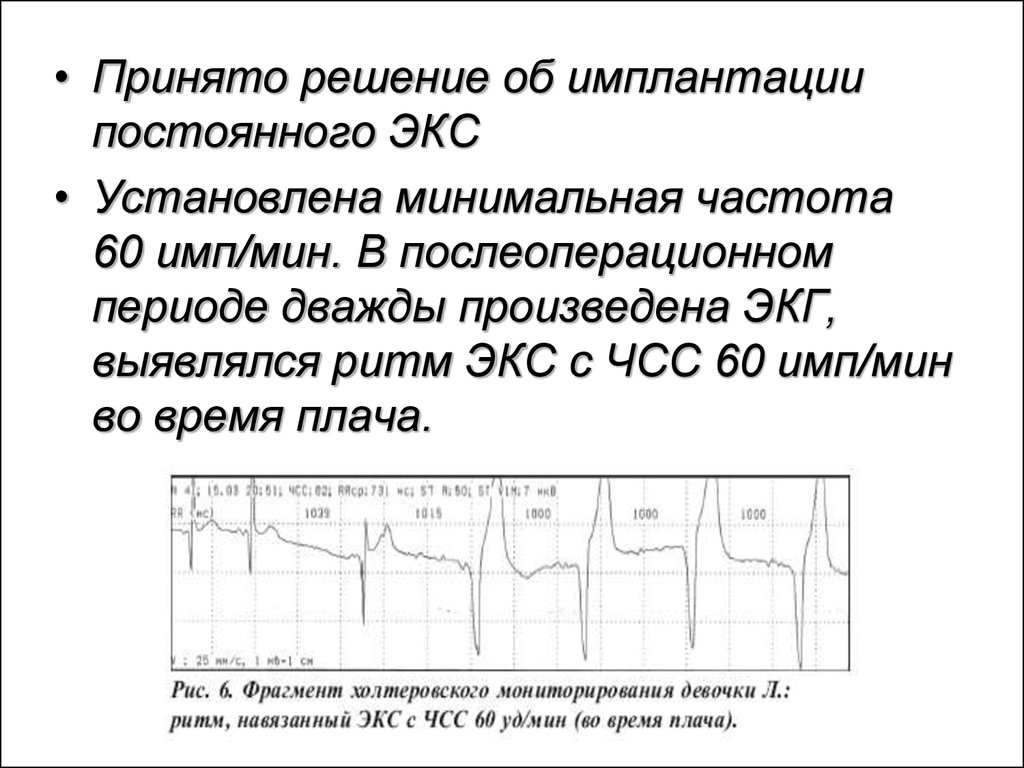 Минимальная частота. ЧСС АВ узла. ЧСС при имплантации экс. Ритм экс. S имп ЭКГ.