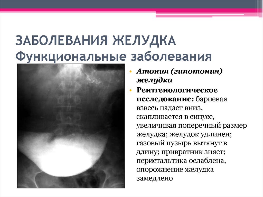 Гипотония и атония. Функциональные болезни желудка. Рентгенодиагностика заболеваний желудка. Атония желудка и гипотония желудка.