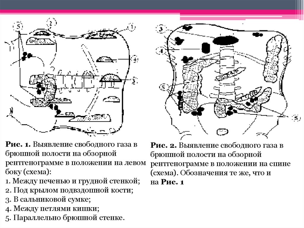 Полость свободно. Свободный ГАЗ В брюшной полости рентген схема. Признаки свободного газа в брюшной полости. Причины газа в брюшной полости. Воздух в брюшной полости симптомы.