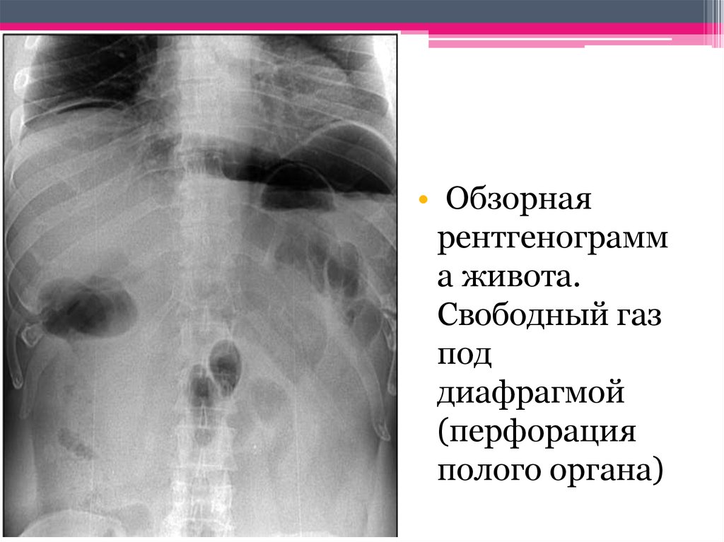 Свободный газ. Рентген брюшной полости при перфорации язвы желудка. Перфорация полого органа в брюшной полости рентген. Свободный ГАЗ рентген при перфорации. Обзорная рентгенография перфорация полого органа.