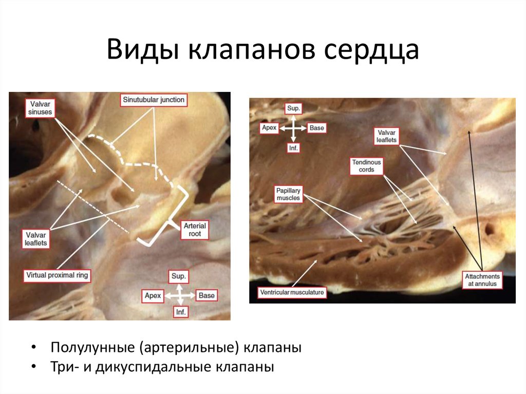 Протезы клапанов сердца виды