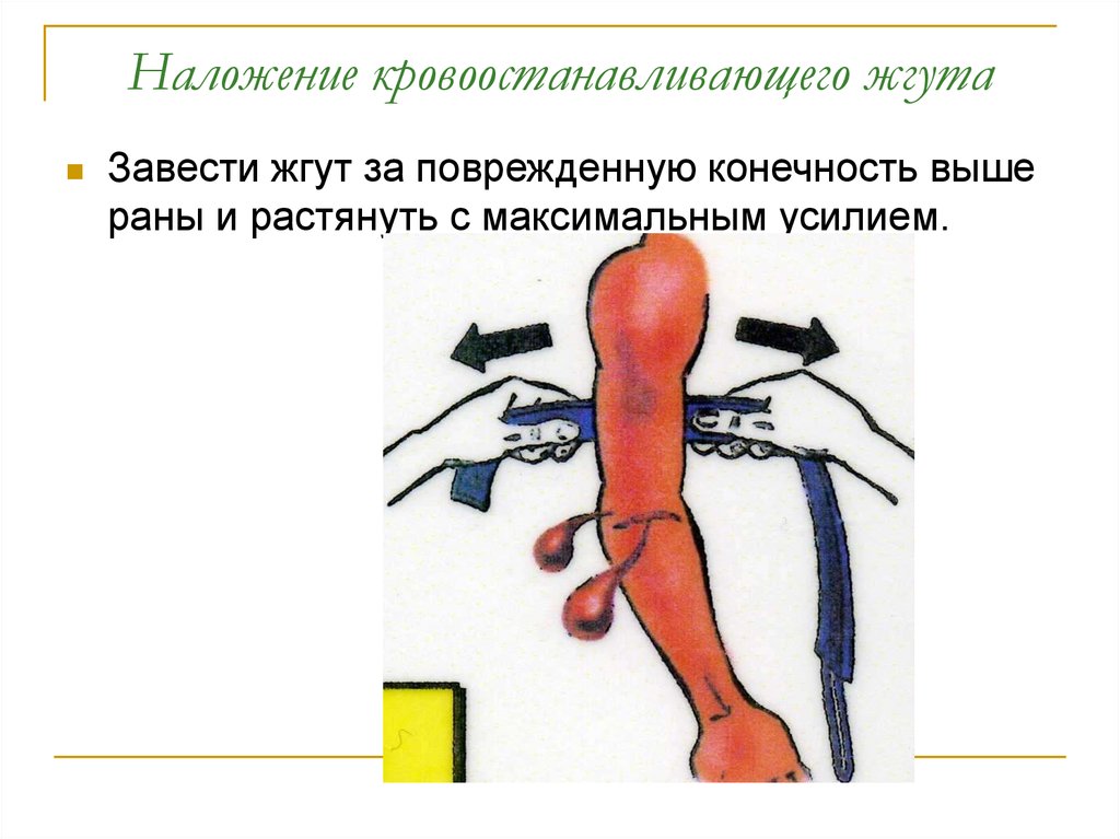 Выше раны. Наложение кровоостанавливающего жгута. Техника наложения кровоостанавливающего жгута. Метока наложения кровоостанавливающего жгута.. Техника наложения жгута Эсмарха.