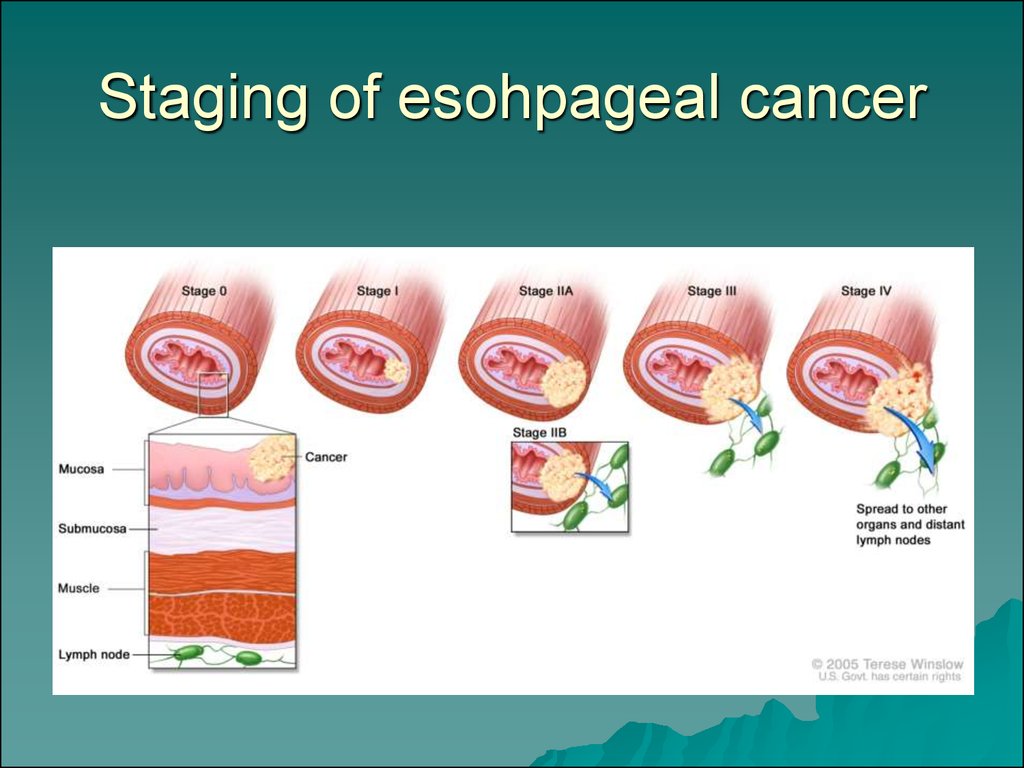 Esophageal cancer, stomach cancer - презентация онлайн