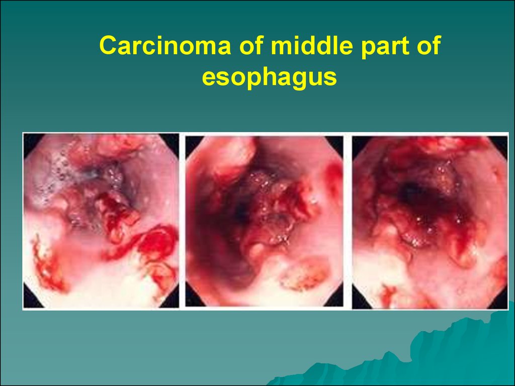 Esophageal cancer, stomach cancer - презентация онлайн