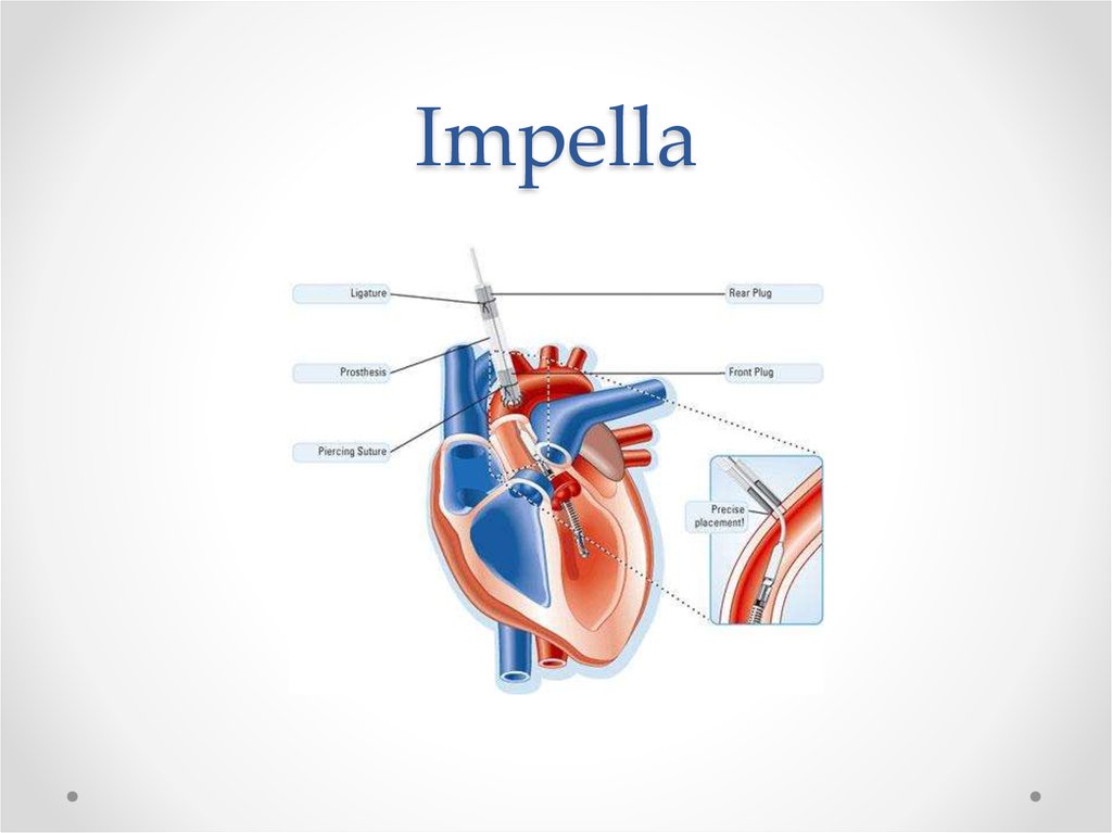 Левый желудочек аорта. Импелла. Impella кардиология. Impella устройство. Impella желудочек.