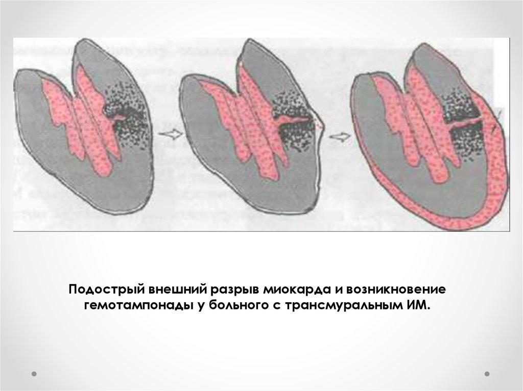 Разрыв сердца. Разрыв миокарда при инфаркте. Разрыв сердца при инфаркте миокарда. Внешний разрыв миокарда. Наружные разрывы сердца.