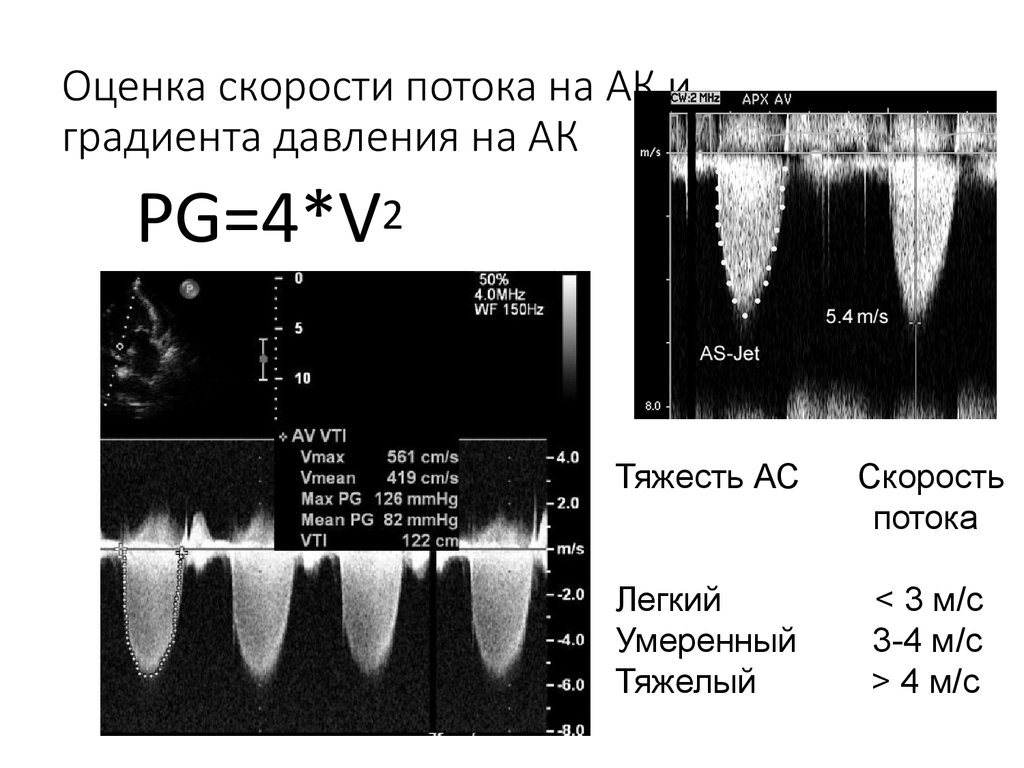 Градиент митрального клапана. Средний градиент давления на аортальном клапане в норме. Норма градиента давления в аортальном клапане ЭХОКГ. Градиент давления на аортальном клапане измерение. Градиент при стенозе аортального клапана.