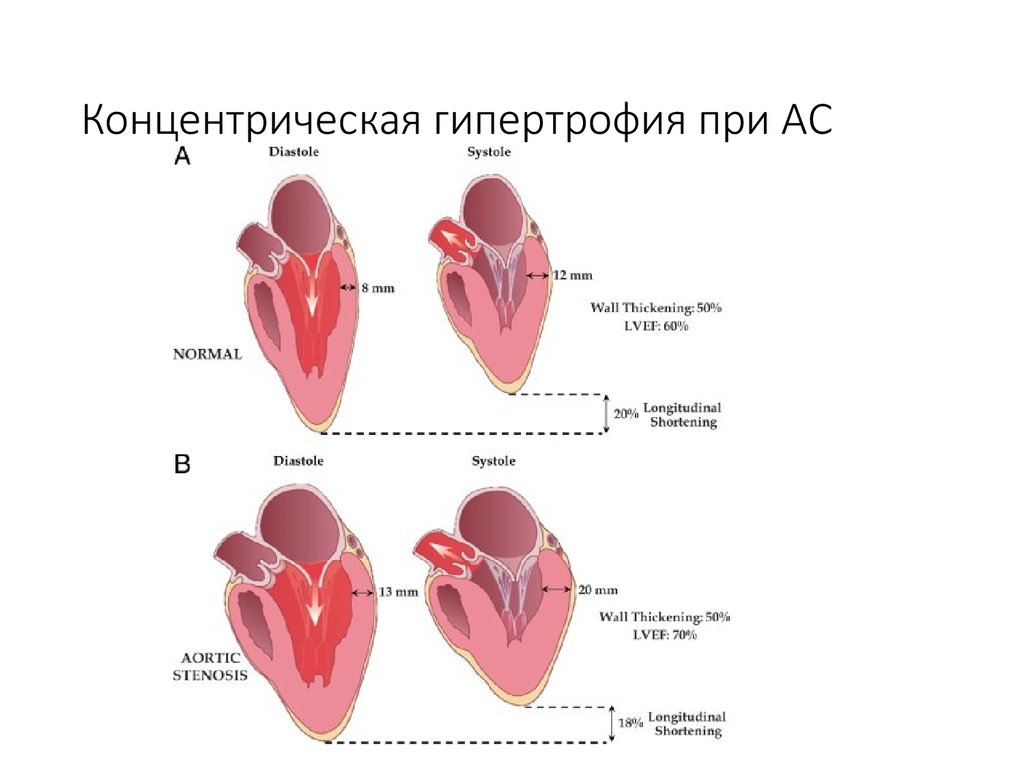 Гипертрофия это. Эксцентрическая гипертрофия сердца. Концентрическая и эксцентрическая гипертрофия левого желудочка. Эксцентрическая гипертрофия миокарда левого желудочка. Концентрическая гипертрофия миокарда лж.