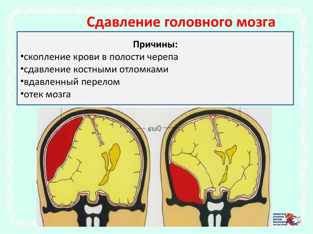 Сдавление головного мозга гематомой. Сдавление головного мозга. Причины сдавления головного мозга. Скопление крови в полости черепа. Сдавление ствола мозга.