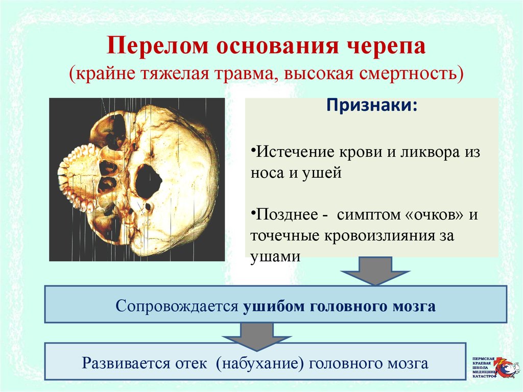 Почему повреждение продолговатого мозга. Признак не характерный для перелома основания черепа. Симптомы при переломе основания черепа. Перелом основания черепа симптом очков. Специфический симптом при переломе основания черепа.