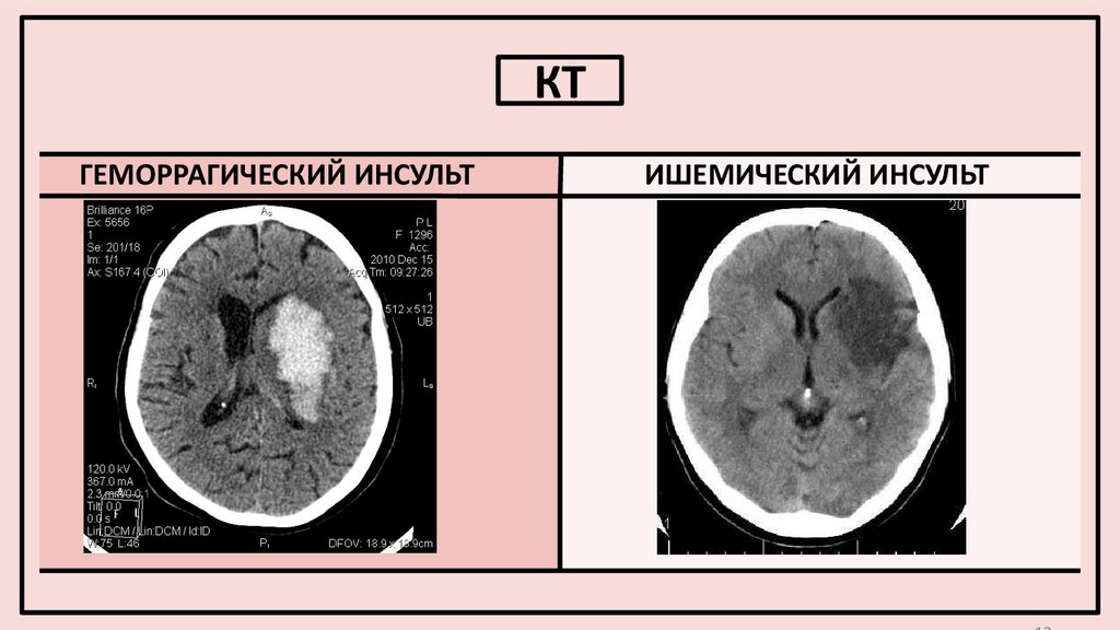 План обследования при ишемическом инсульте