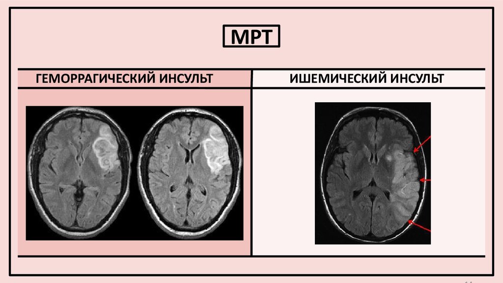 Ишемический инсульт головного мозга на мрт фото