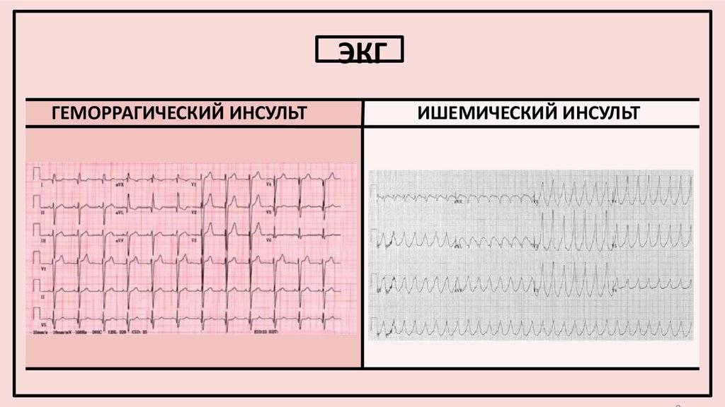 Картинка после инсульта как видят