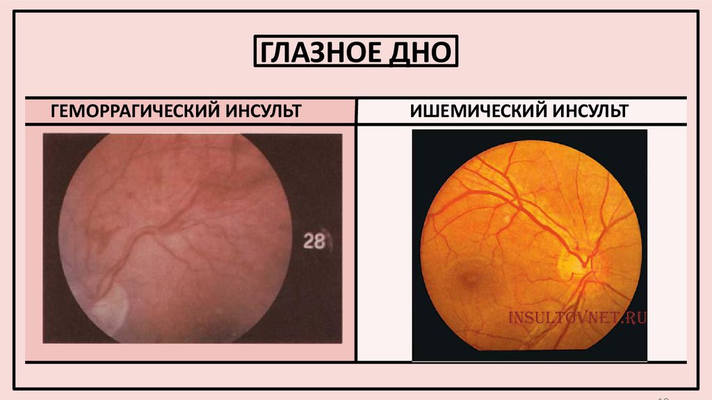 Инсульт глаза. Геморрагический инсульт глазное дно. Глазное дно при ишемическом инсульте. Глазное дно при геморрагическом инсульте. Гоазное Део при инсульте.