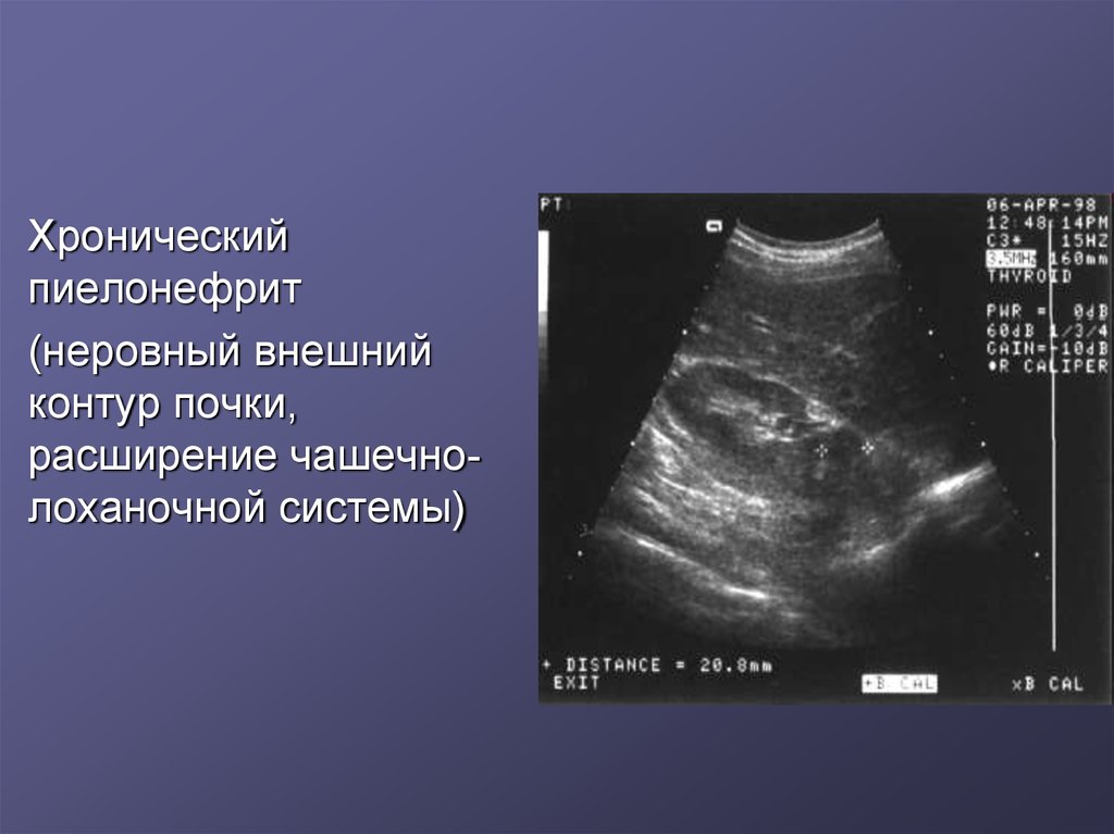 Гломерулонефрит узи картина