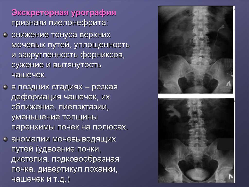 Экскреторная урография картинки