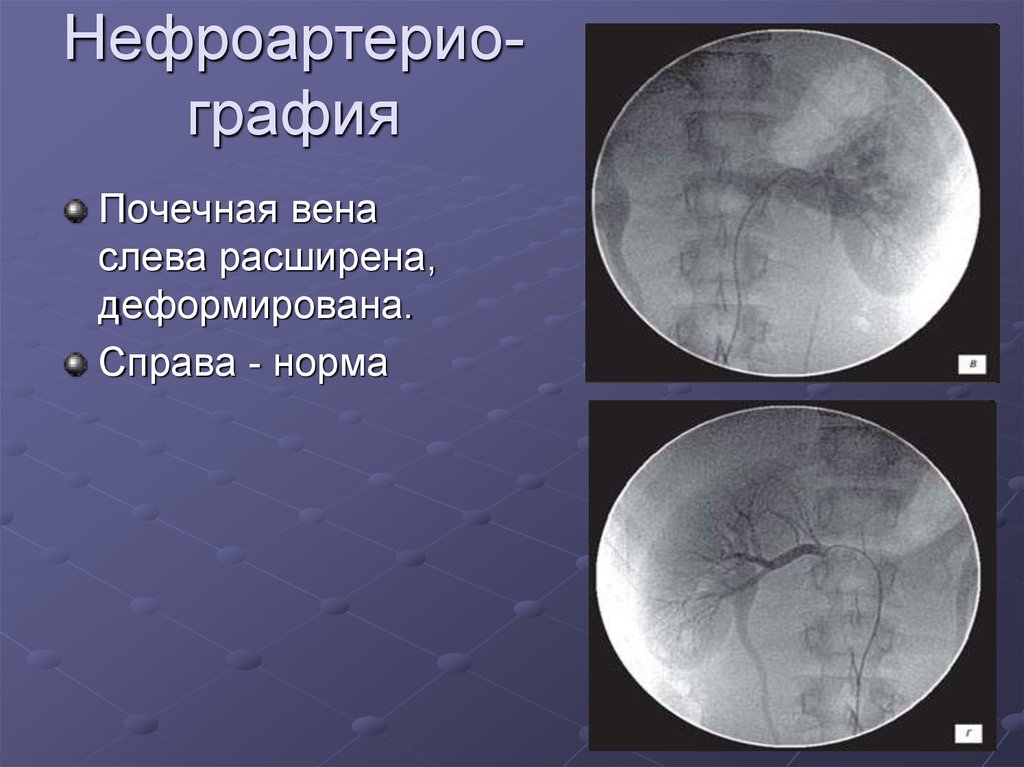 Расширена почечная. Расширение почечной вены. Кольцевидная почечная Вена слева. Расширение почечной вены на УЗИ. Расширение левой почечной вены.