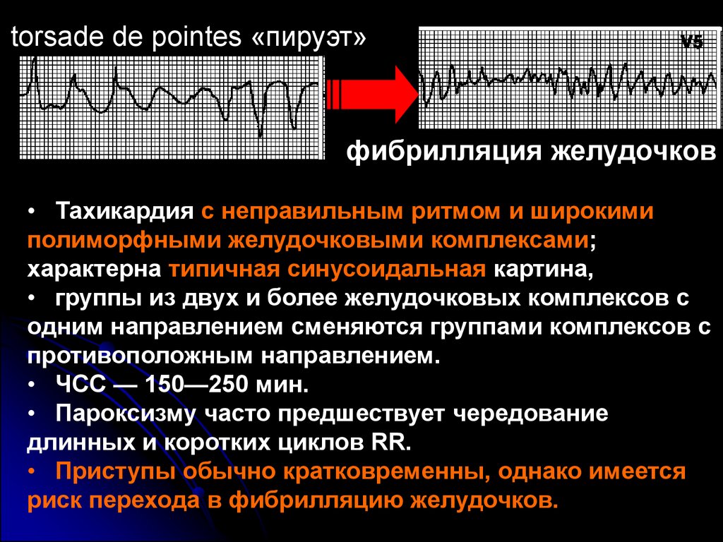 Тахикардия типа пируэт