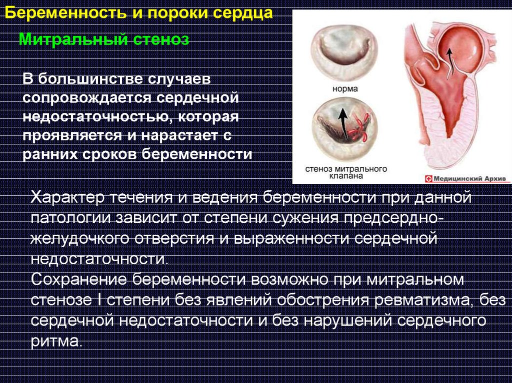 Порок сердца продолжительность жизни. Пороки сердца и беременность. Порок сердца у ребенка при беременности. Пороки сердца при беременности.