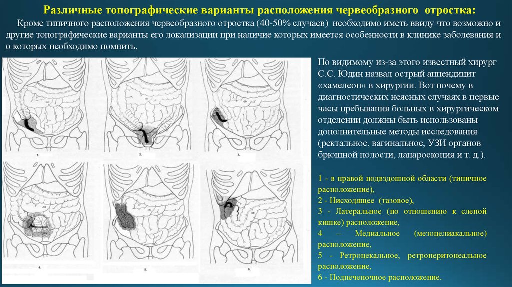 Расположение аппендицита