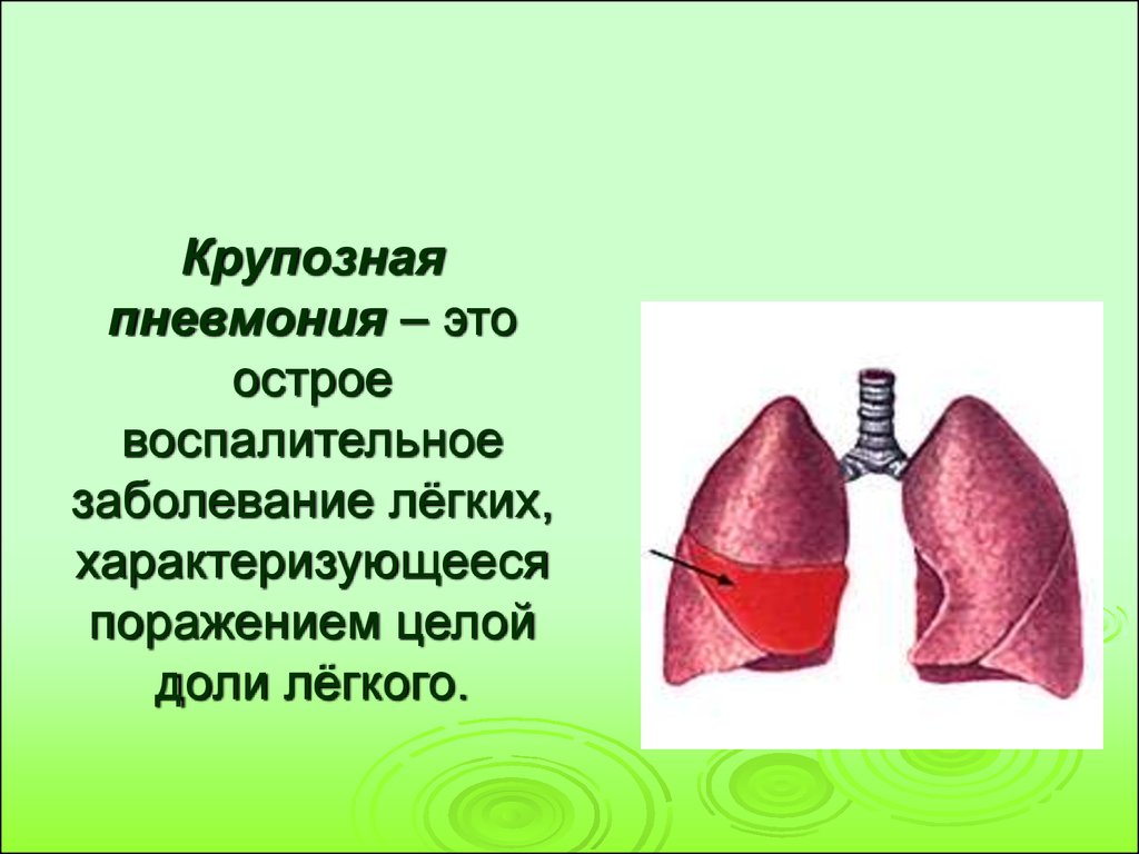 Острая инфекция легких. Воспаление целой доли легкого наблюдается при. Крупозное воспаление легких. Плевропневмония (крупозная) пневмонии.