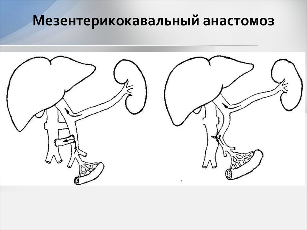 Мезентерикокавальный анастомоз