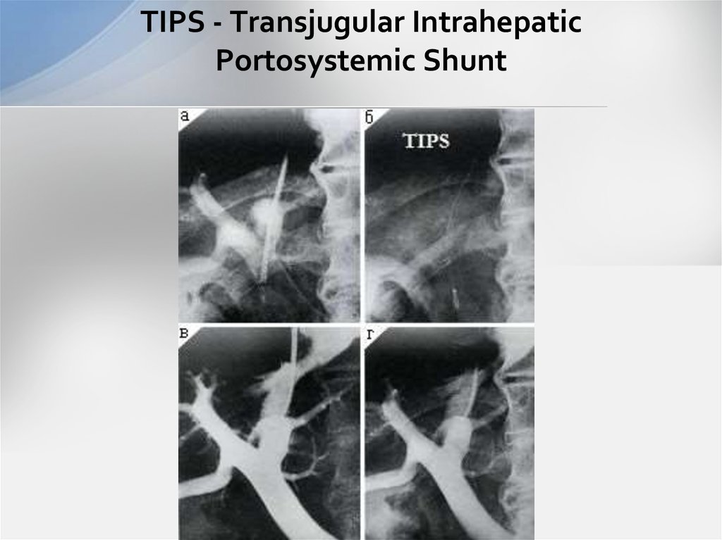 TIPS - Transjugular Intrahepatic Portosystemic Shunt