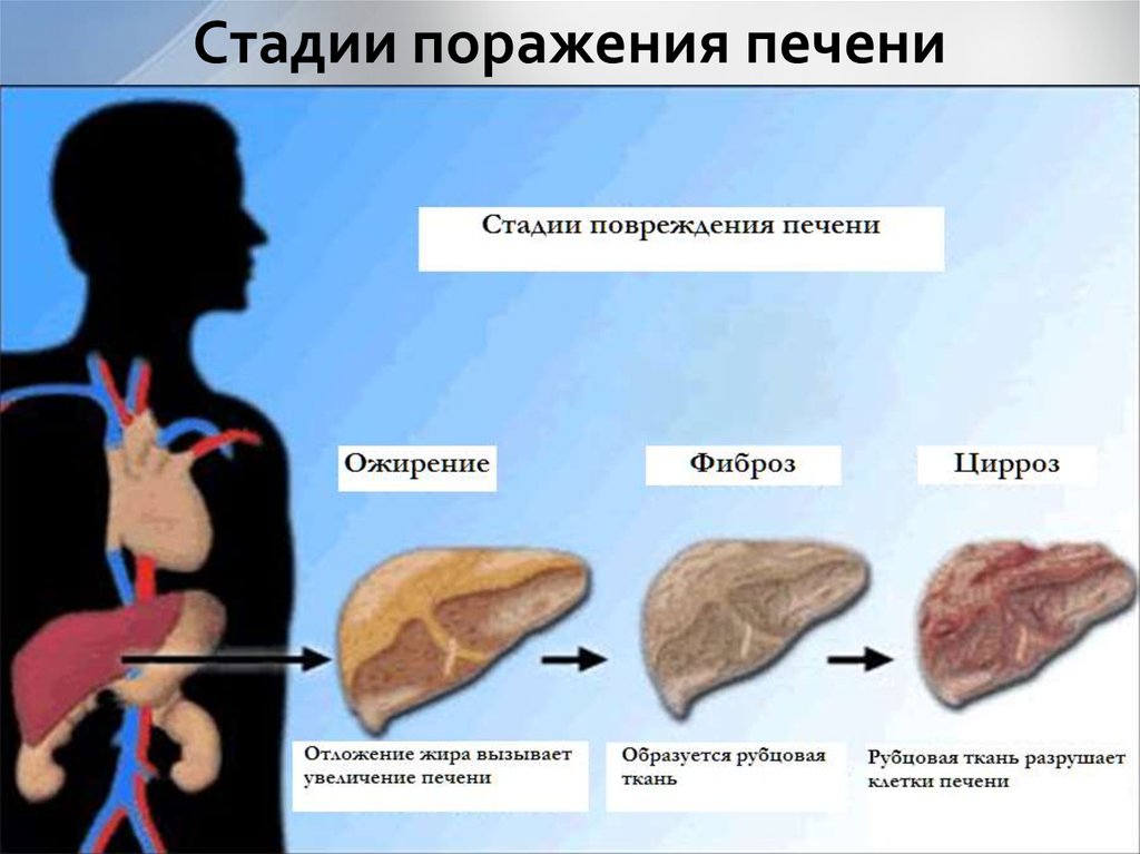 Стадии поражения печени
