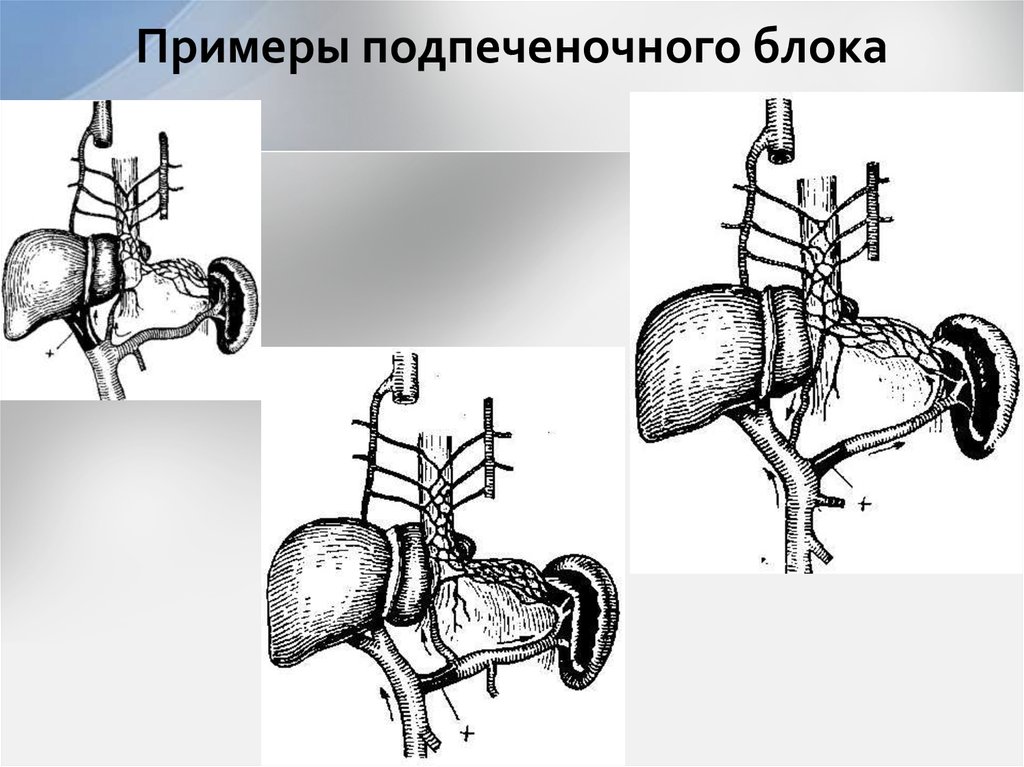 Примеры подпеченочного блока