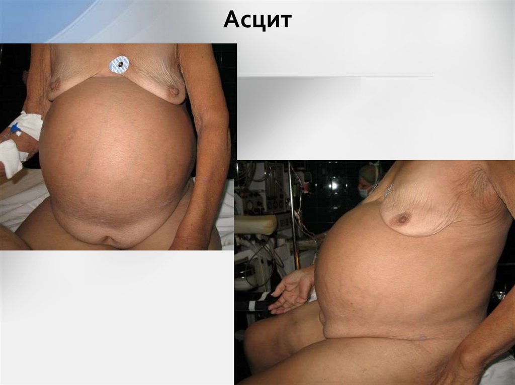 Асцит