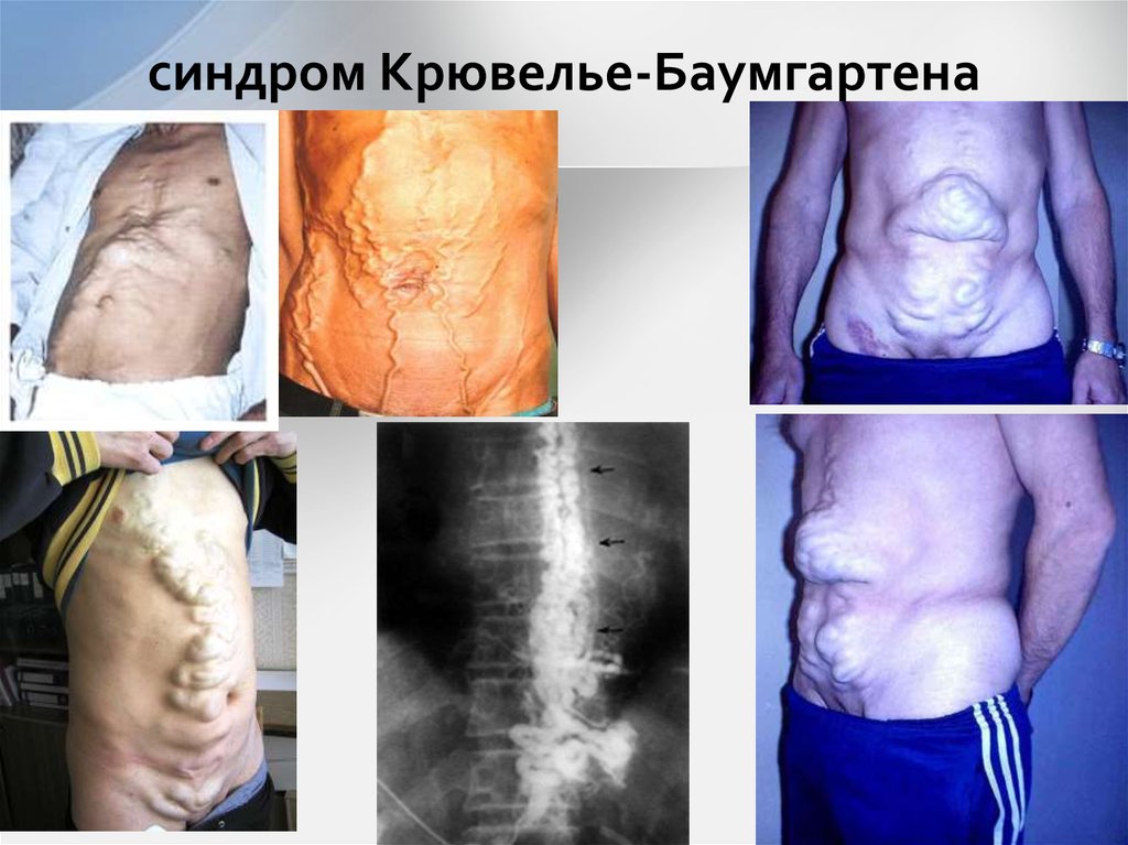 синдром Крювелье-Баумгартена