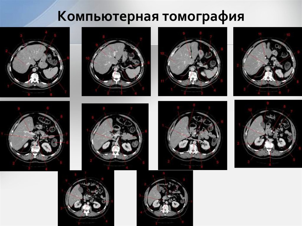 Компьютерная томография
