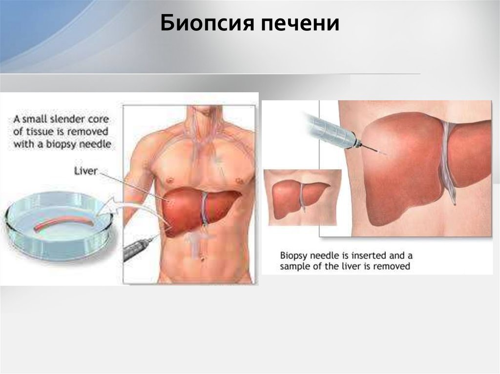 Биопсия печени