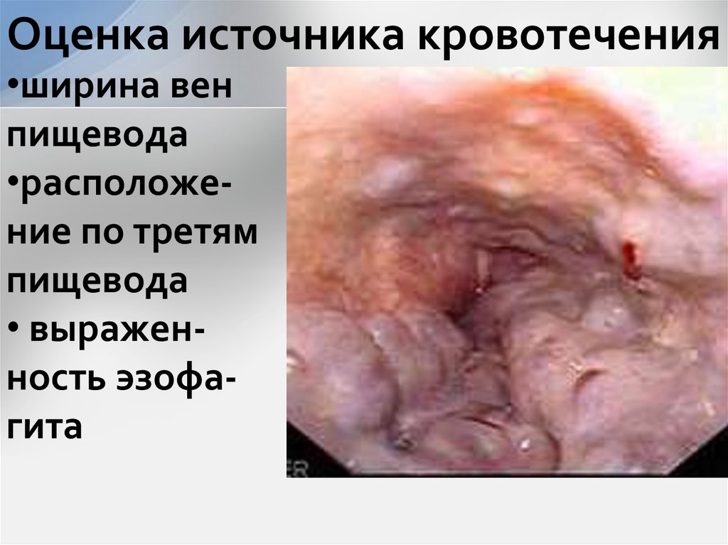 Оценка источника кровотечения