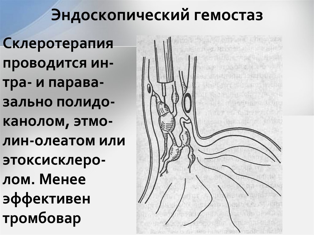 Эндоскопический гемостаз