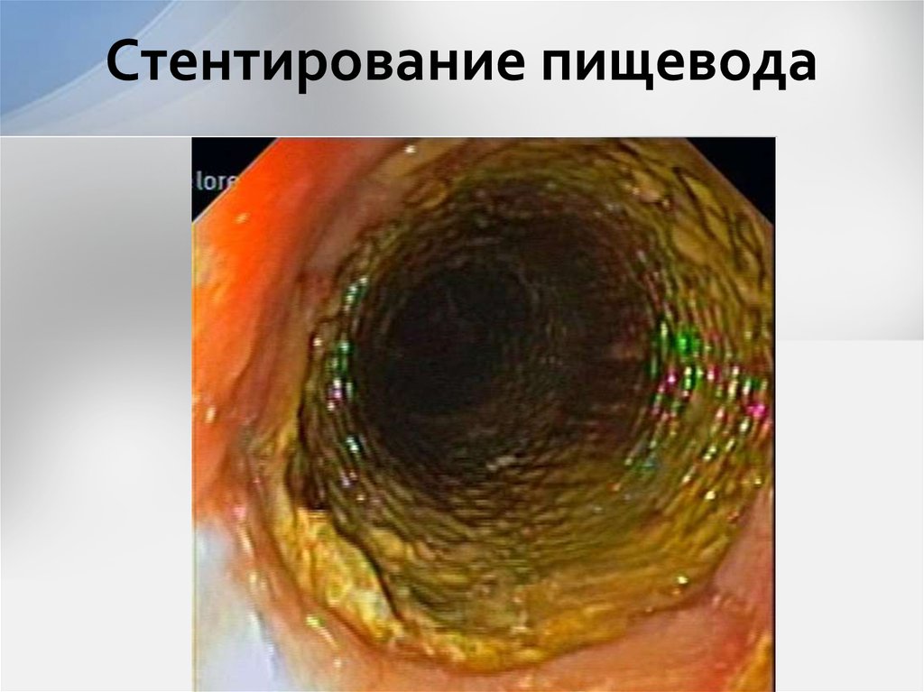 Стентирование пищевода