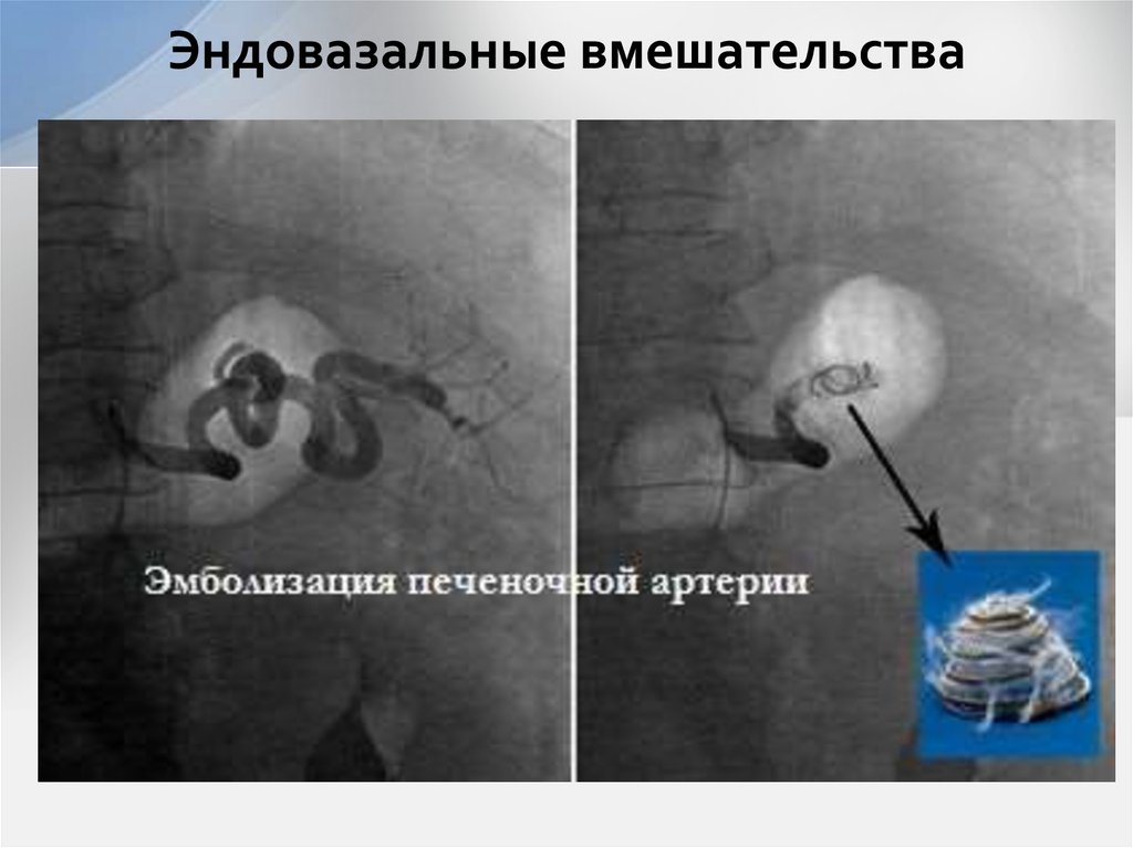 Эндовазальные вмешательства