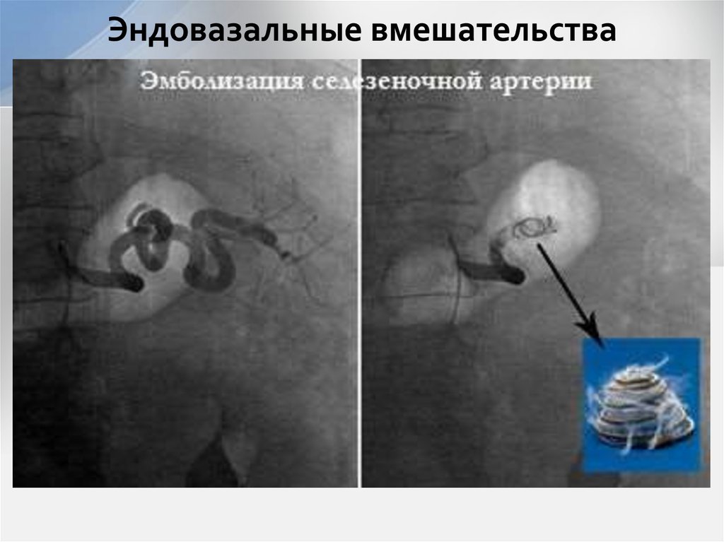 Эндовазальные вмешательства