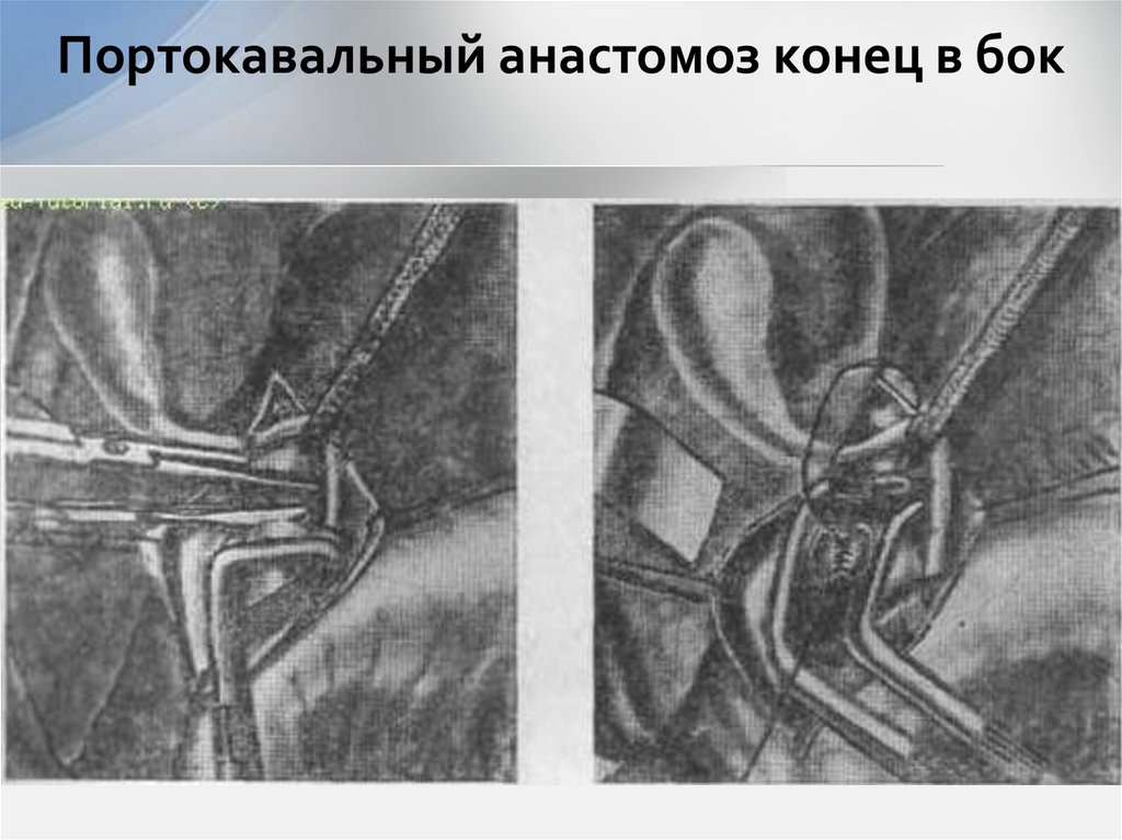 Портокавальный анастомоз конец в бок