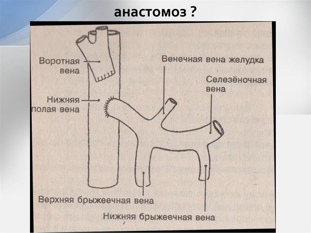 Анастомоз конец в конец схема