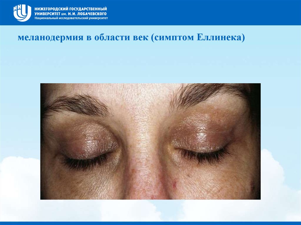 меланодермия в области век (симптом Еллинека)