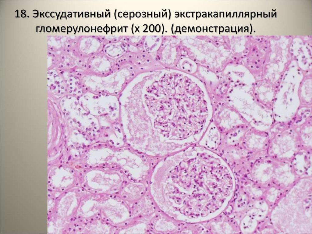 Микроскопическая картина мочи при гломерулонефрите